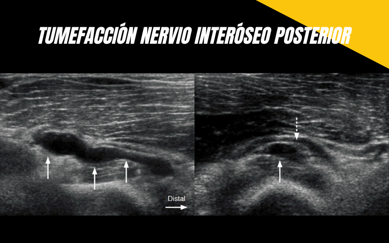 4. Nervio Interoeo Posterior Ecografia Tempo Formacion.png